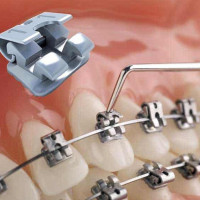 Metal Brackets