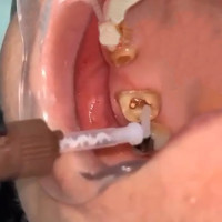 Dual Cure Core Build-Up