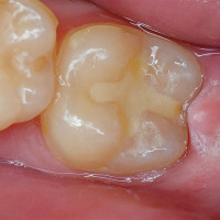 Glass Ionomer for Filling
