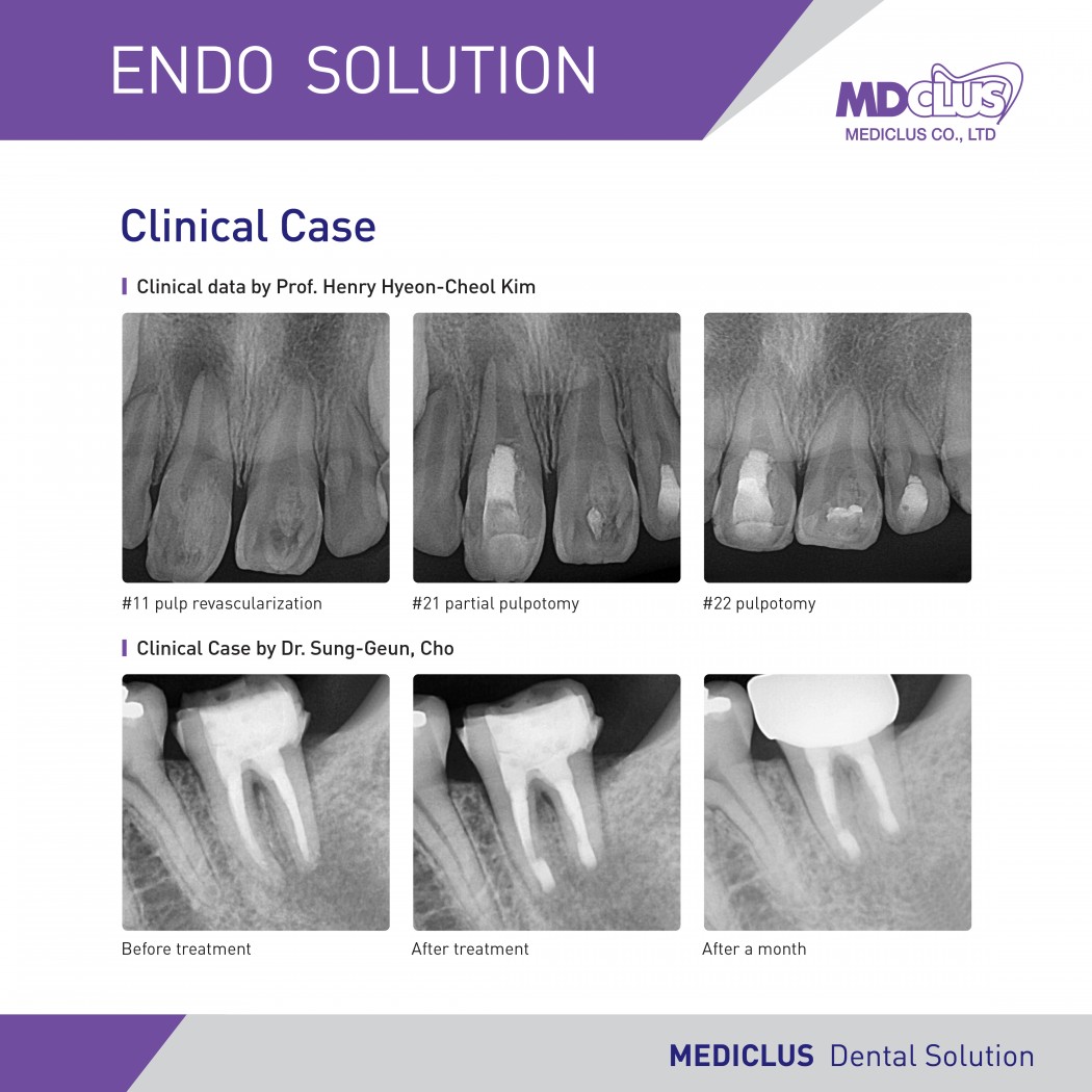 MdClus One-Fil Putty (Injectable)